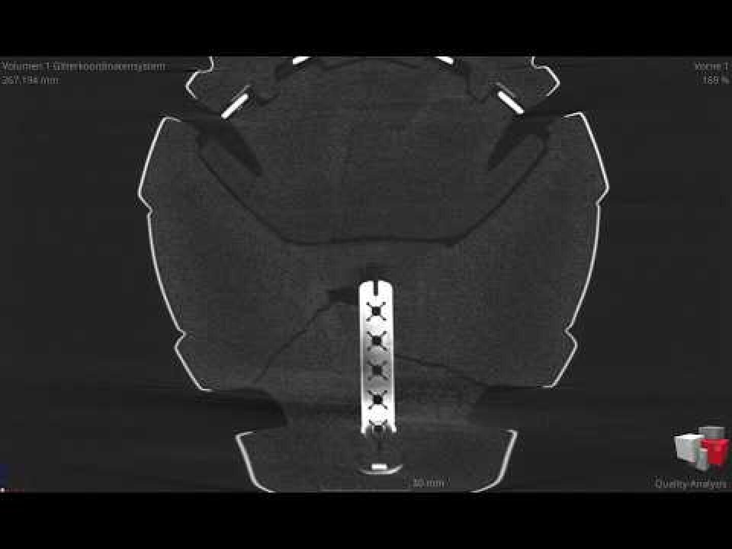 Schwarz-Weiß-CT-Aufnahme, die einen Querschnitt eines Knochens zeigt, in dessen Mitte ein orthopädisches Metallimplantat mit Schrauben befestigt ist. Weiße Konturen heben die Knochenränder hervor, und in der rechten unteren Ecke sind Symbole zu sehen.